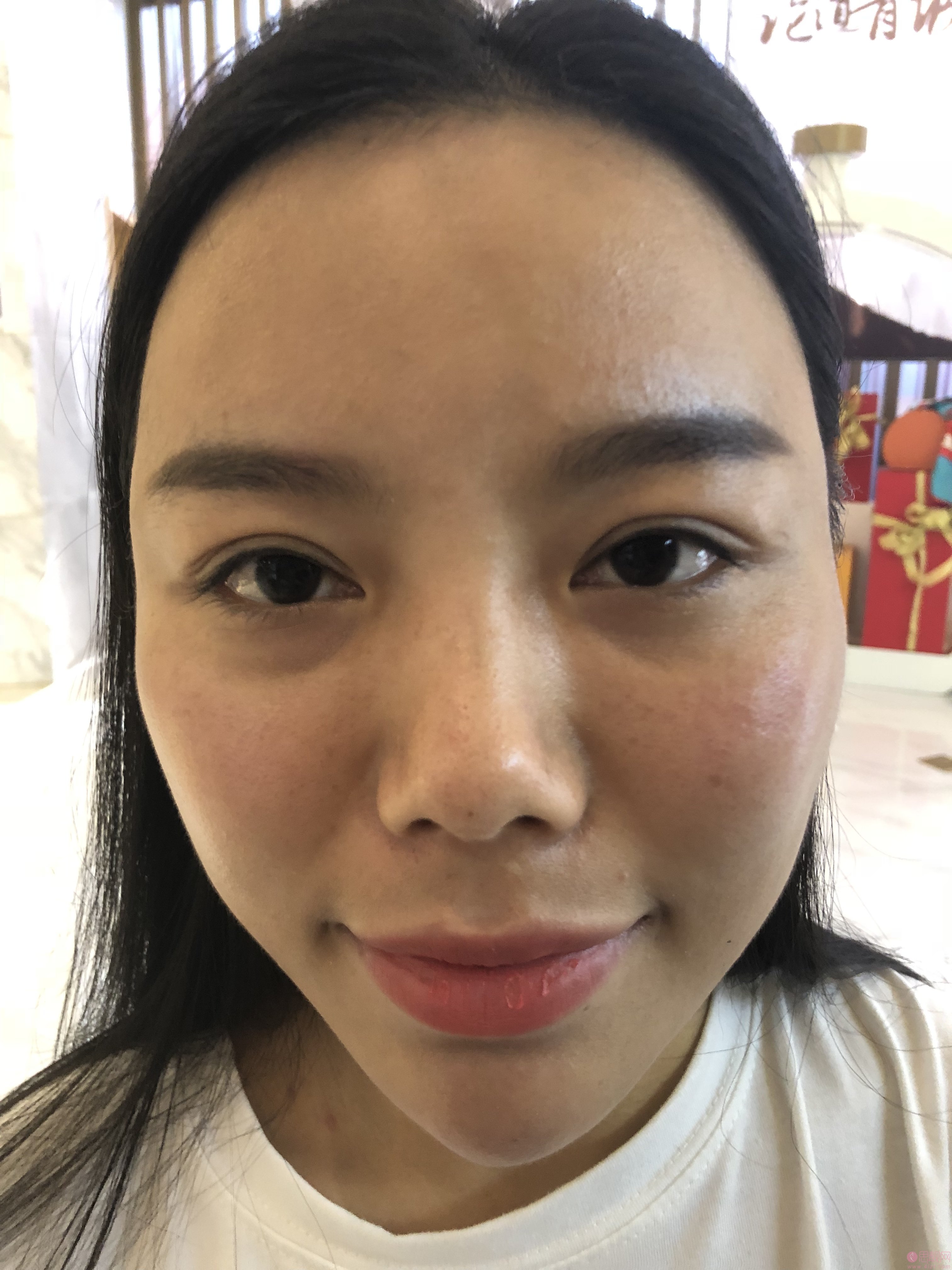 成都铜雀台刘溪隆鼻价格表曝光+术后真人案例分享