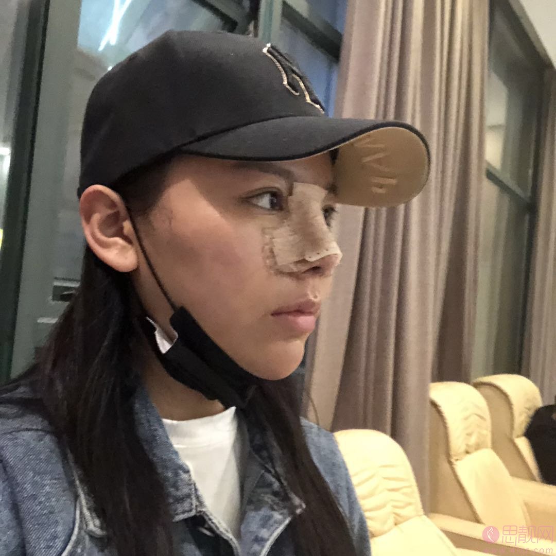 成都铜雀台刘溪隆鼻价格表曝光+术后真人案例分享