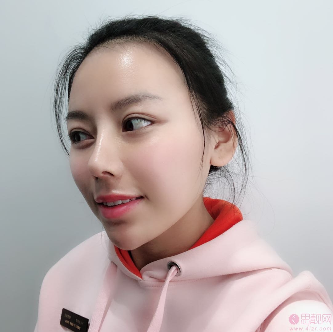 成都铜雀台刘溪隆鼻价格表曝光+术后真人案例分享
