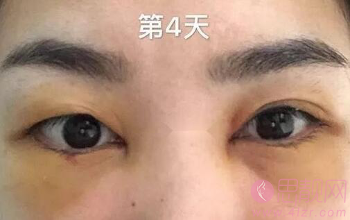 成都华西割眼袋好不好?附案例及2021年价格表公开
