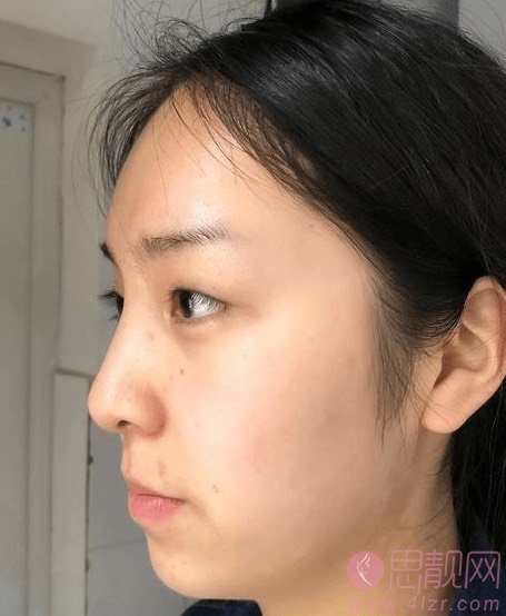 吴玉家双眼皮做得好么？附双眼皮真人案例分享+2021年价格表一览