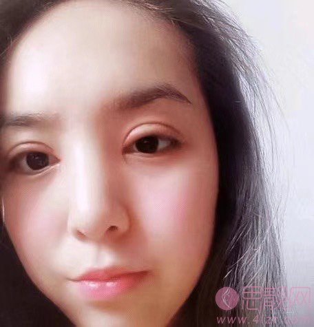 吴玉家双眼皮做得好么？附双眼皮真人案例分享+2021年价格表一览