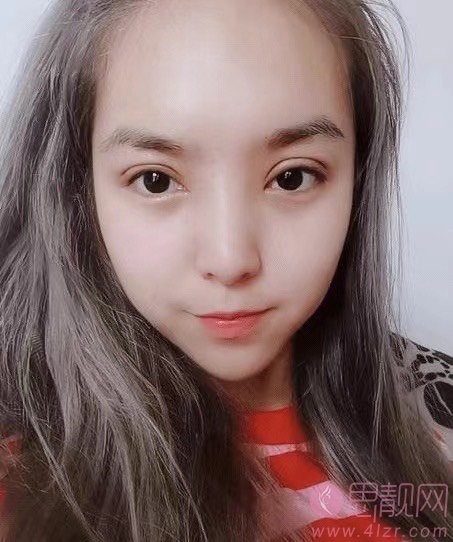吴玉家双眼皮做得好么？附双眼皮真人案例分享+2021年价格表一览