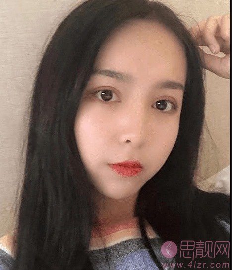 吴玉家双眼皮做得好么？附双眼皮真人案例分享+2021年价格表一览
