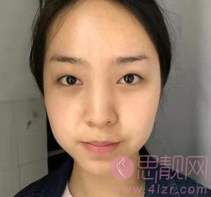 郑州张朝蕾医院怎么样?术后双眼皮真人案例分享+2021年价格表曝光