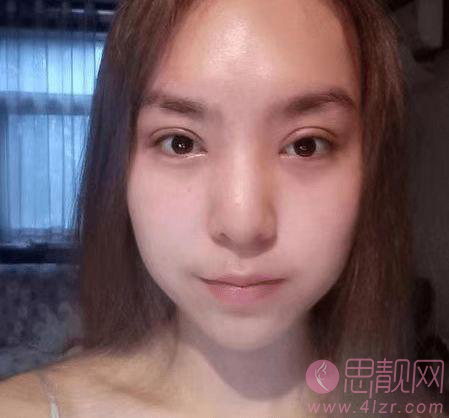 郑州张朝蕾医院怎么样?术后双眼皮真人案例分享+2021年价格表曝光