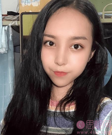 郑州张朝蕾医院怎么样?术后双眼皮真人案例分享+2021年价格表曝光