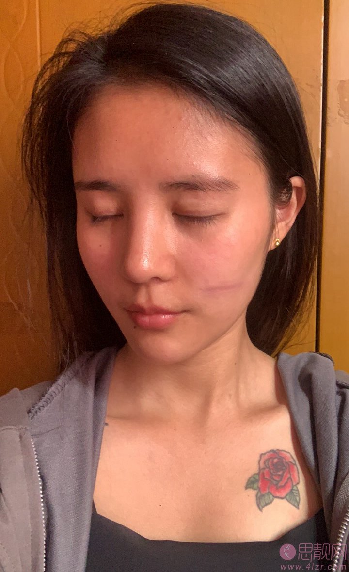 成都医大疤痕研究院靠谱吗？附祛疤真人案例反馈