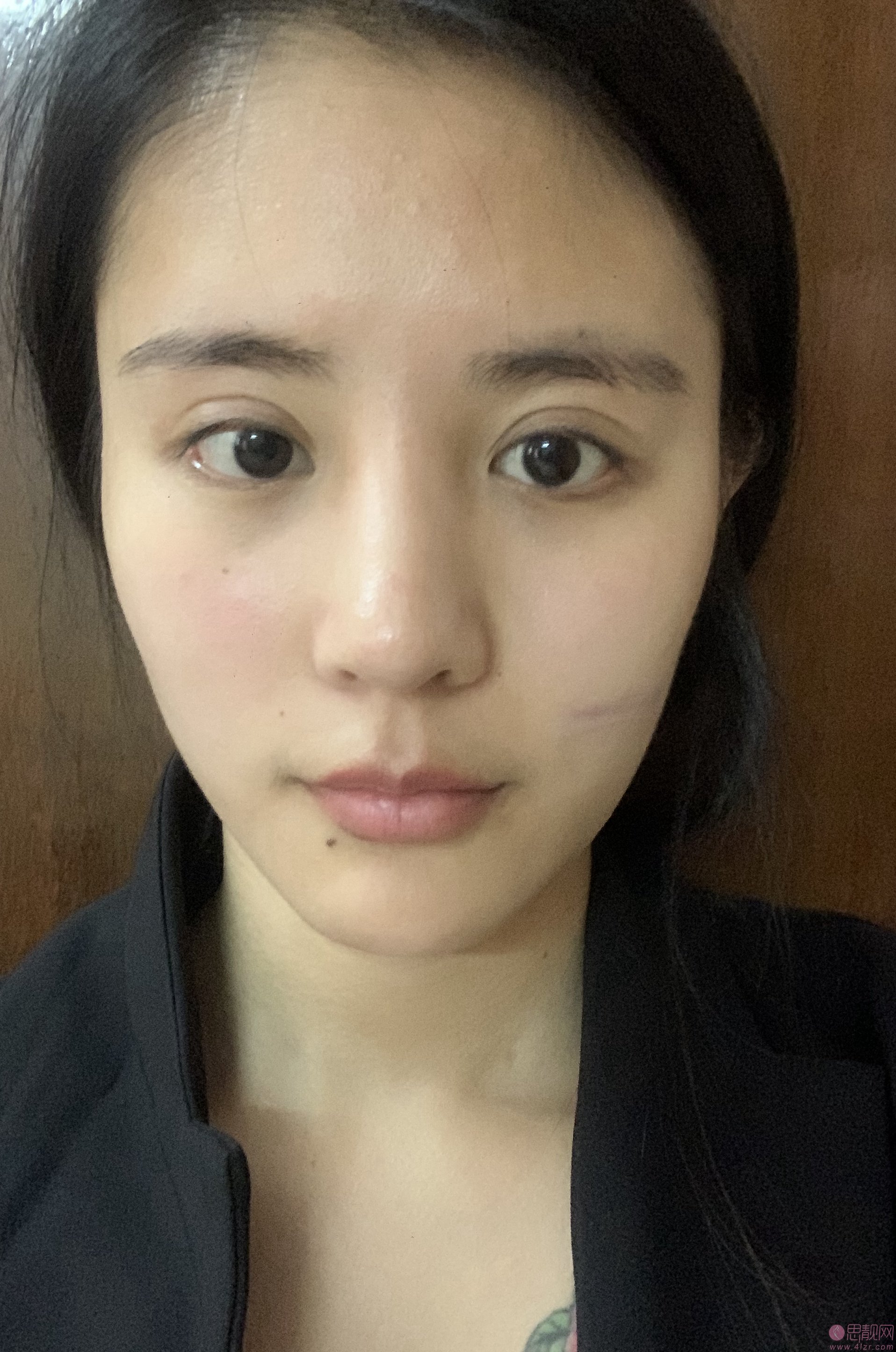 成都医大疤痕研究院靠谱吗？附祛疤真人案例反馈