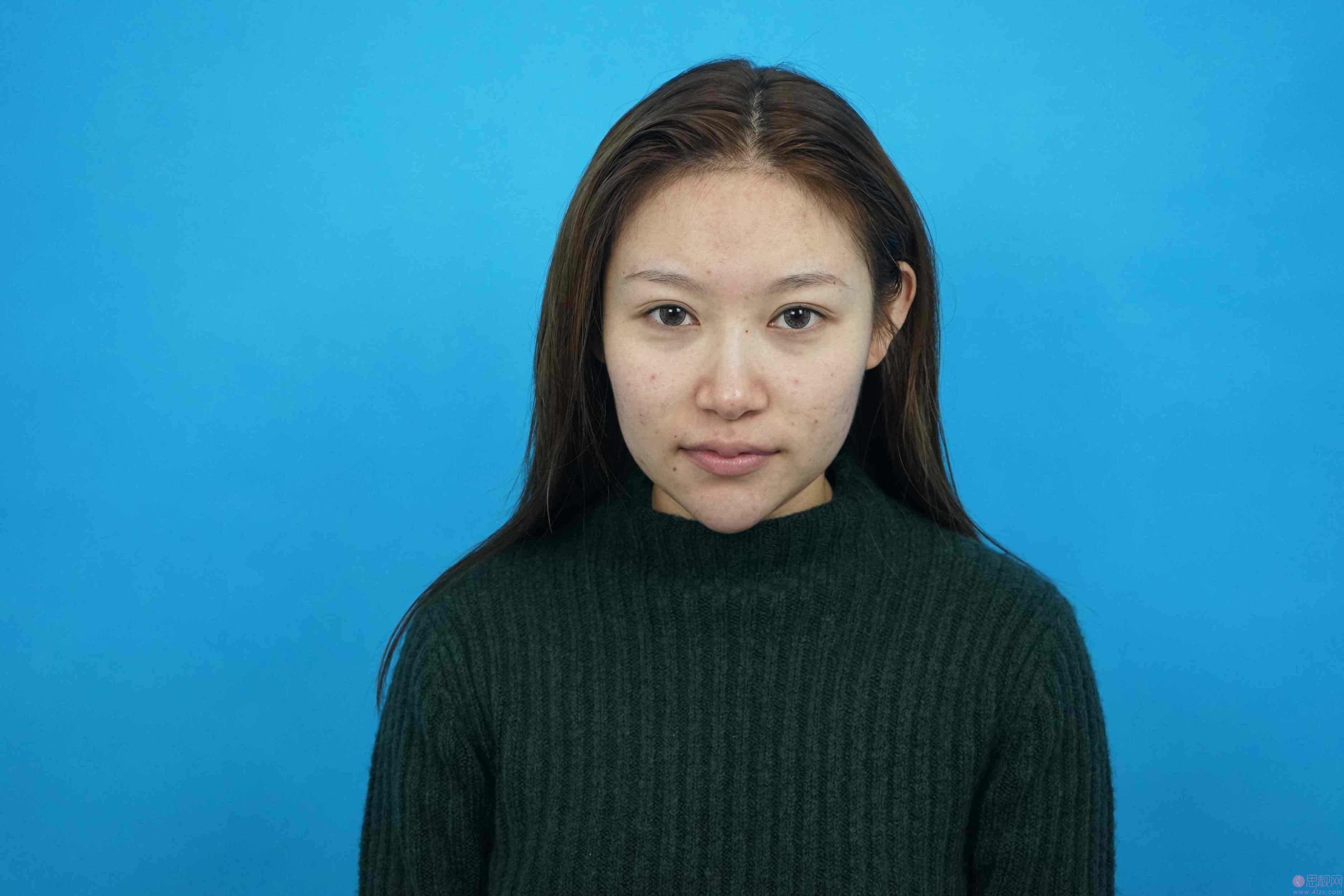 沈阳创美荟医疗美容鲁传龙医生果酸祛痘真人案例分享+2021年价格表发布