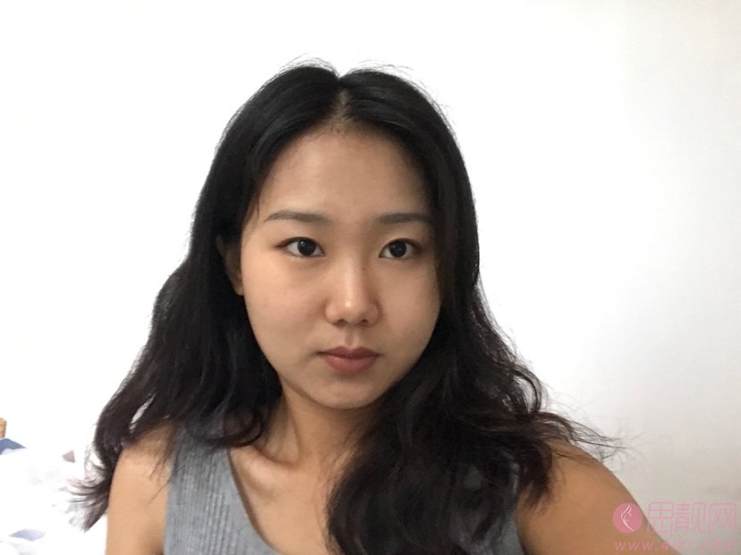 上海九院汪希做双眼皮怎么样?真人案例效果图分享