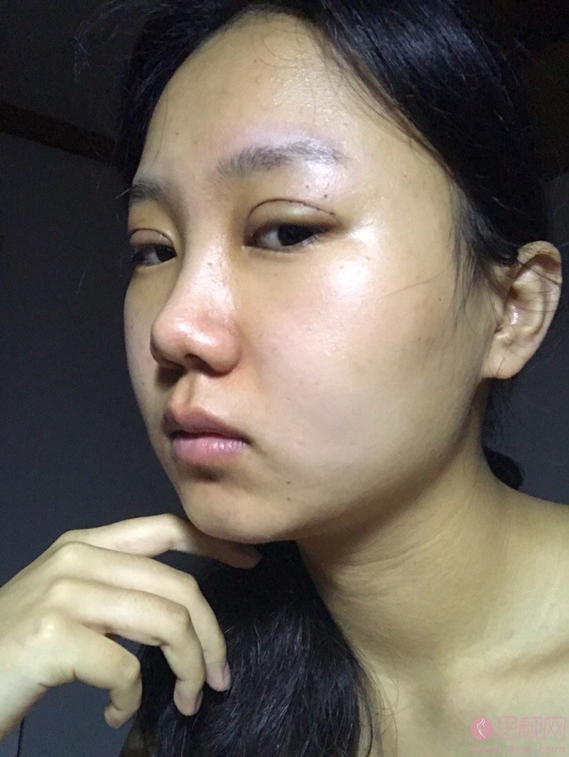 上海九院汪希做双眼皮怎么样?真人案例效果图分享