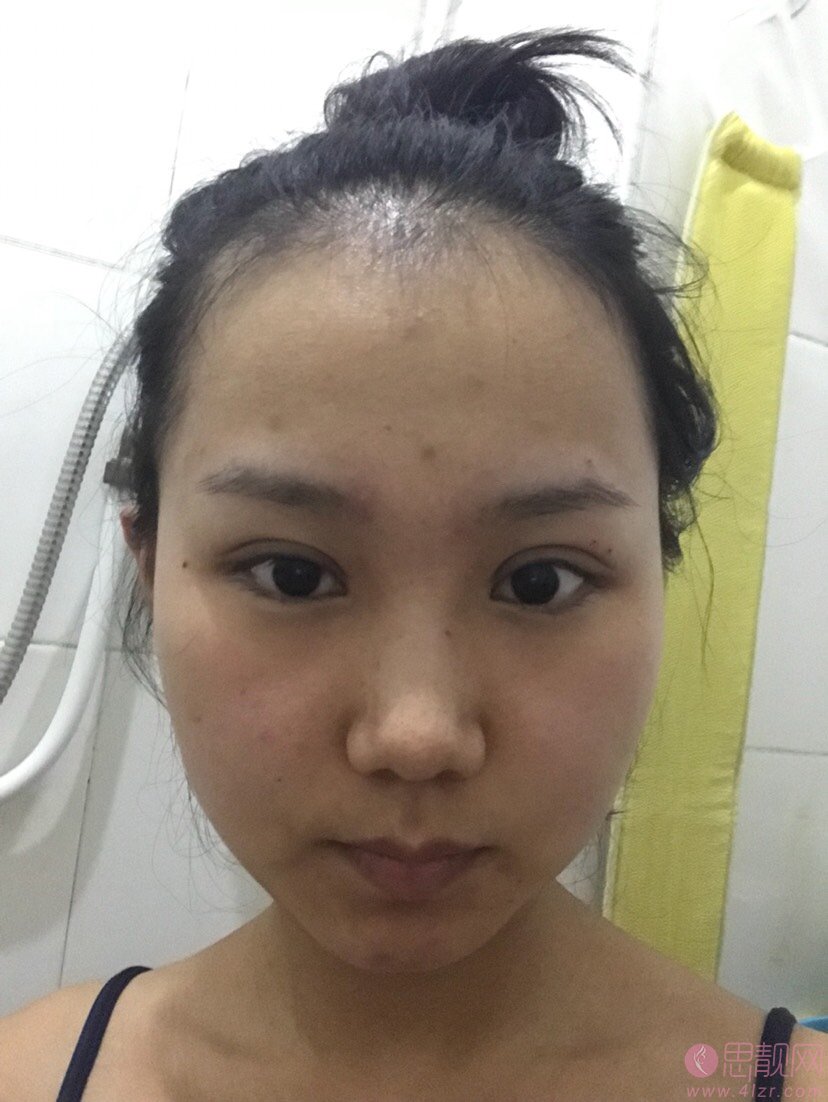 上海九院汪希做双眼皮怎么样?真人案例效果图分享