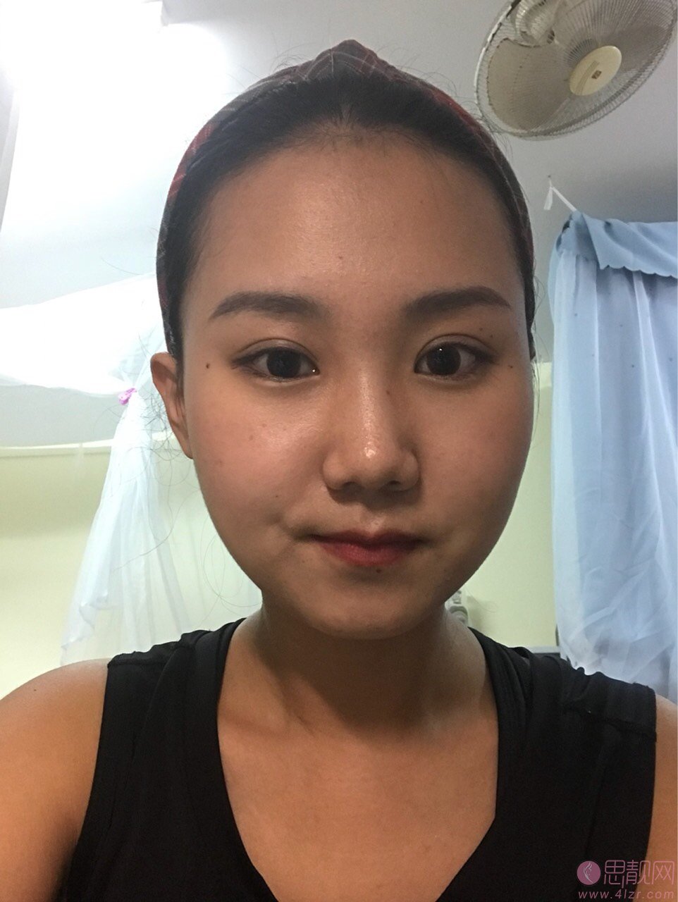 上海九院汪希做双眼皮怎么样?真人案例效果图分享
