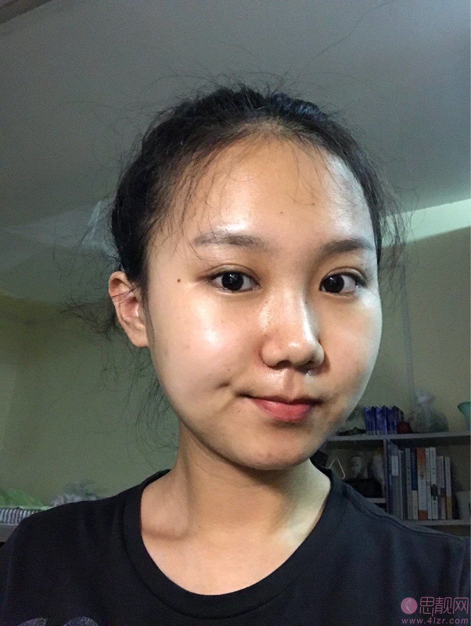 上海九院汪希做双眼皮怎么样?真人案例效果图分享