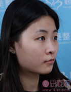合肥恒美整形美容2021年价格表发布+双眼皮真人案例分享