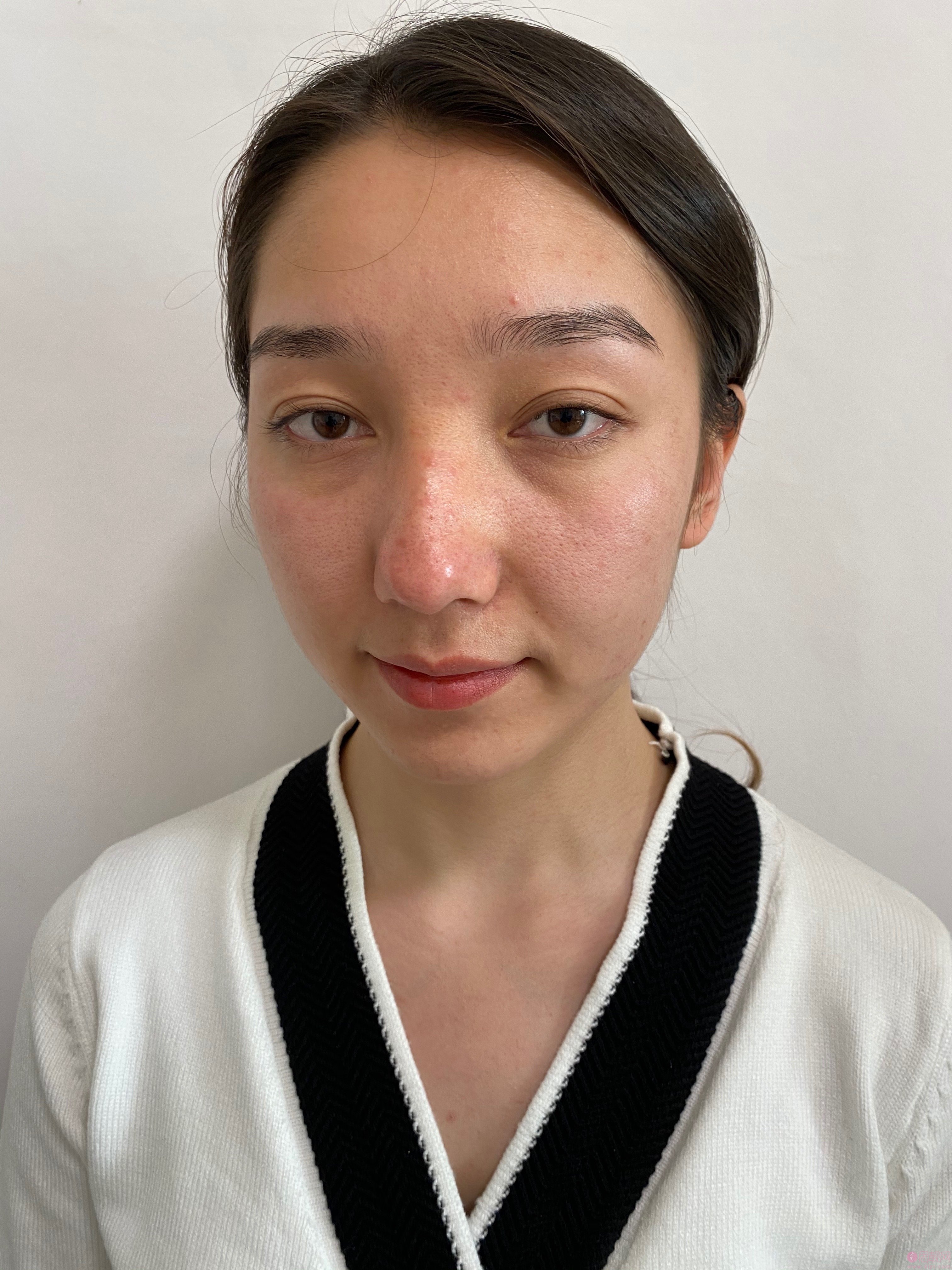 深圳曹孟君医疗美容怎么样?2021年价格表公开+隆鼻案例分享