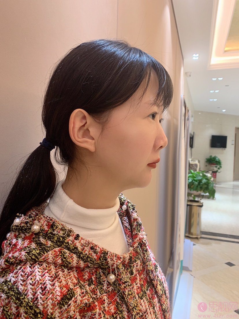 西安美立方李宇翔医生隆鼻怎么样？附隆鼻案例反馈+2021年价格表一览