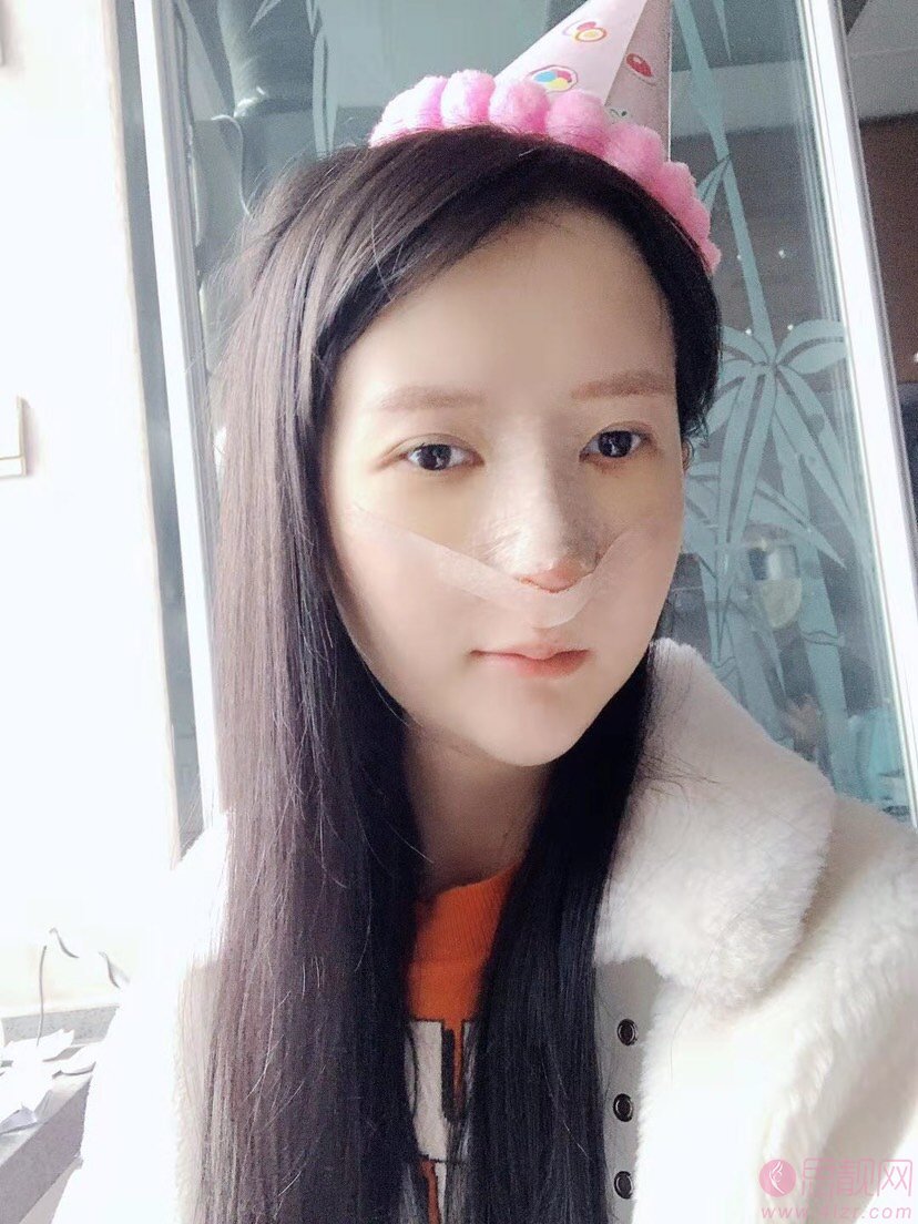 西安美立方李宇翔医生隆鼻怎么样？附隆鼻案例反馈+2021年价格表一览
