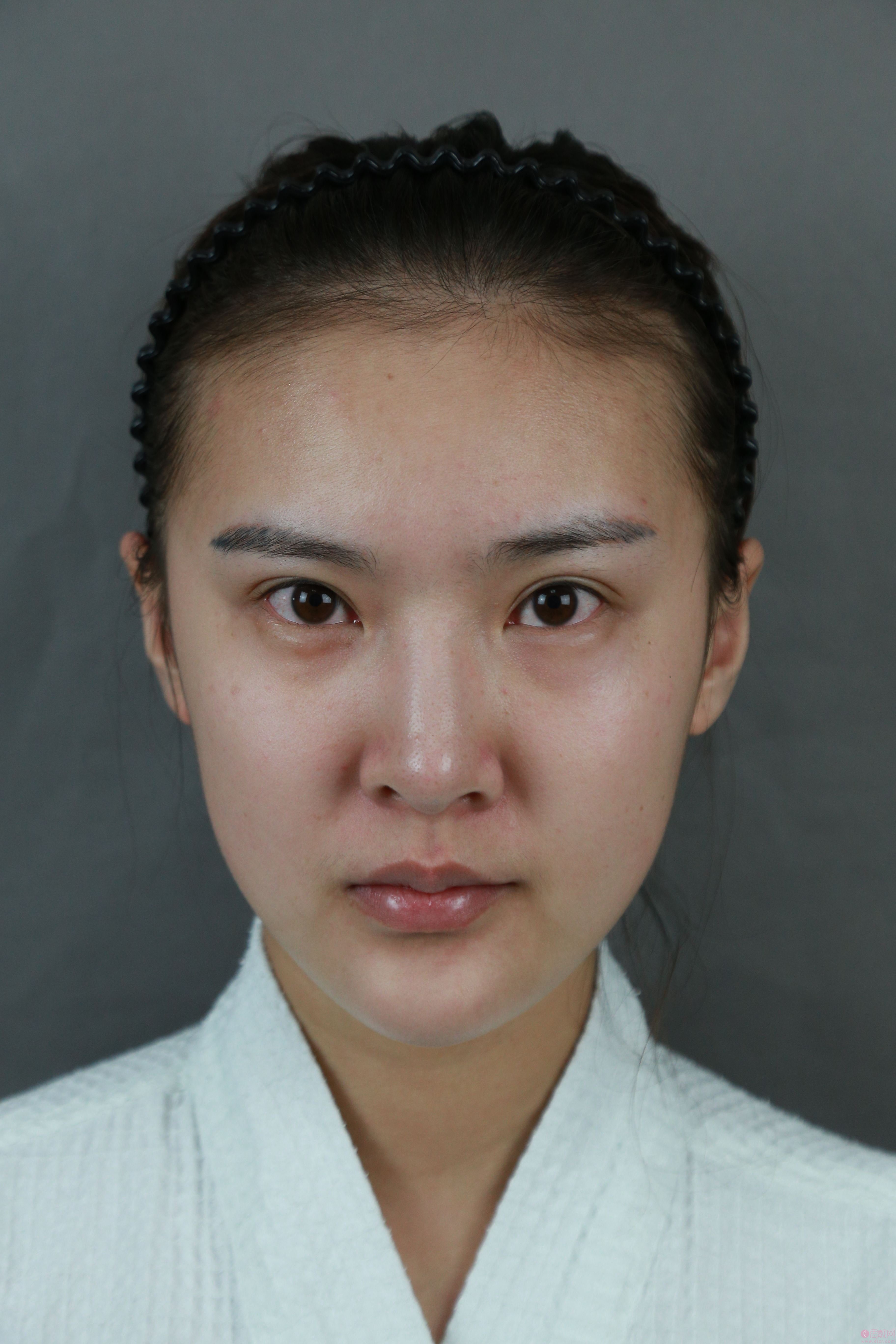 郑州美莱王跃星医生吸脂怎么样？附案例及2021年价格表曝光