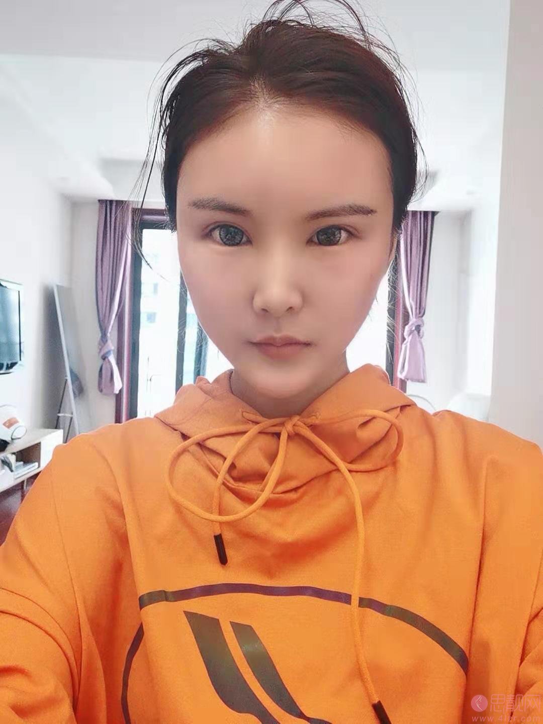 郑州美莱王跃星医生吸脂怎么样？附案例及2021年价格表曝光
