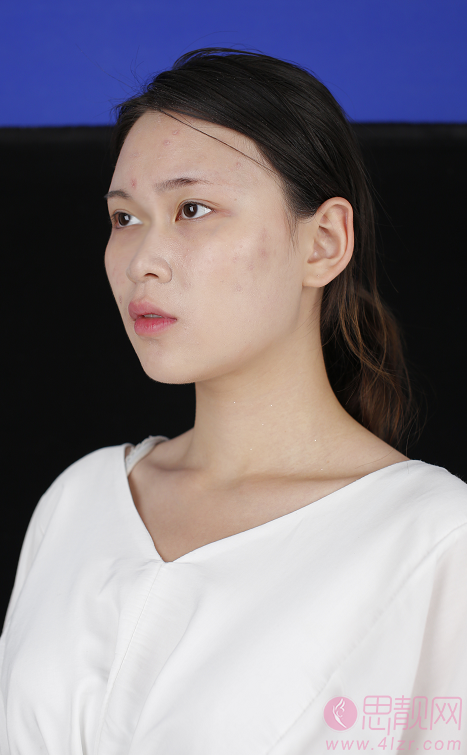 郑州美莱李俊霞医生隆鼻怎么样？术后真人案例分享+2021年价格表发布