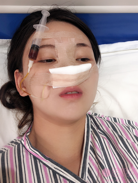 郑州美莱李俊霞医生隆鼻怎么样？术后真人案例分享+2021年价格表发布