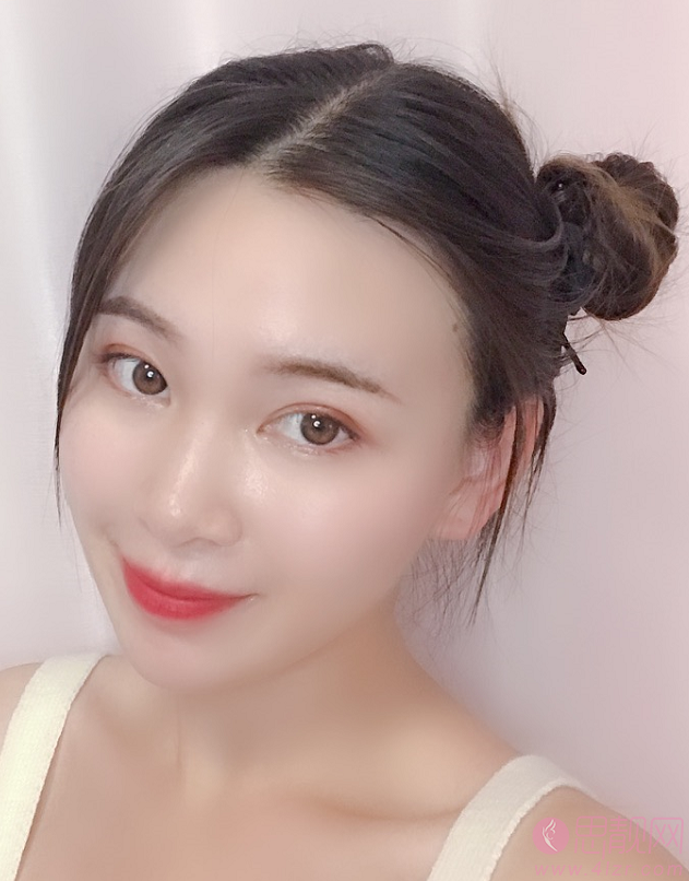 郑州美莱李俊霞医生隆鼻怎么样？术后真人案例分享+2021年价格表发布
