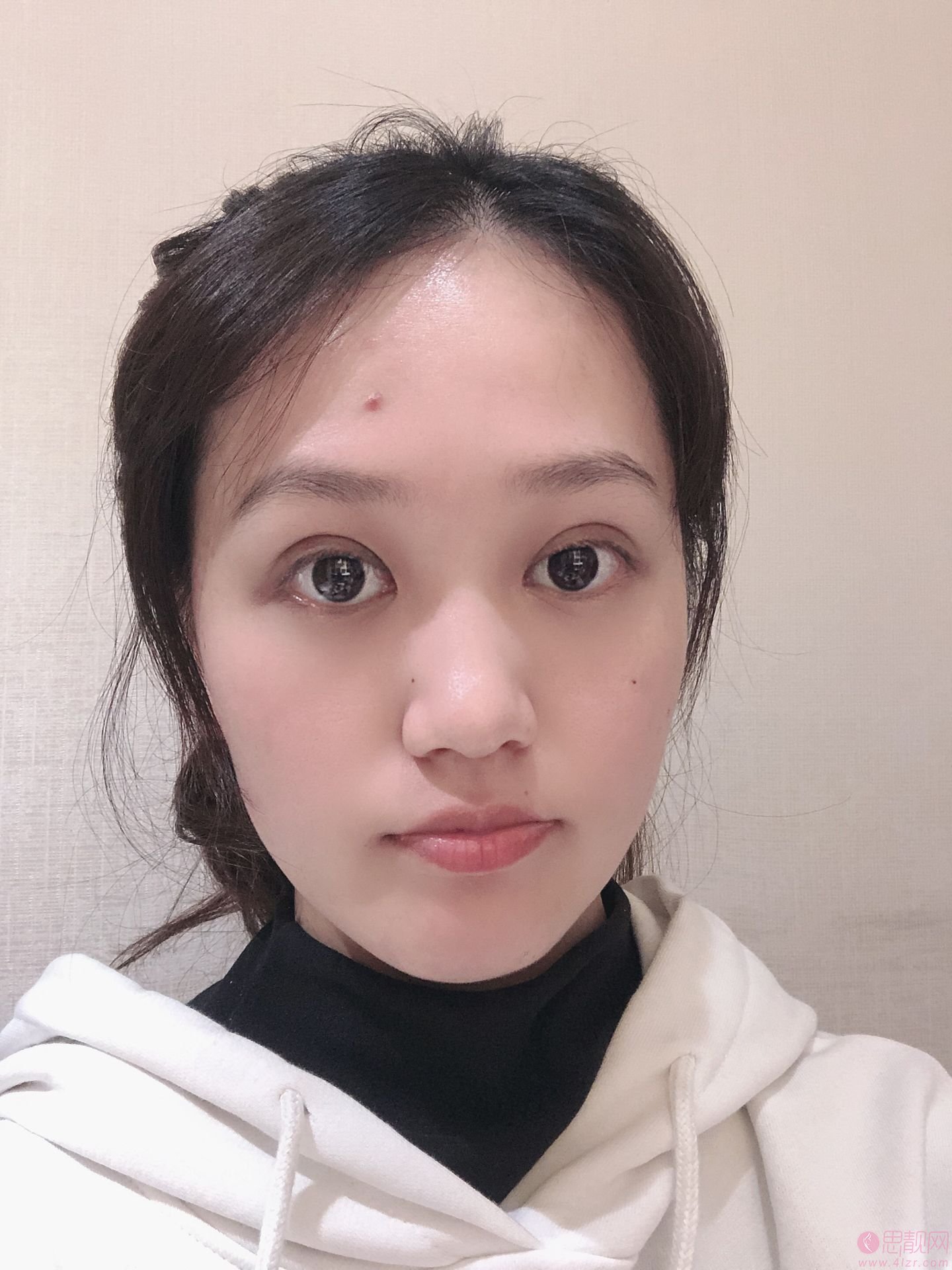 广州韩妃于洪瑞做双眼皮怎么样？附双眼皮真人案例分享+2021年价格表一览