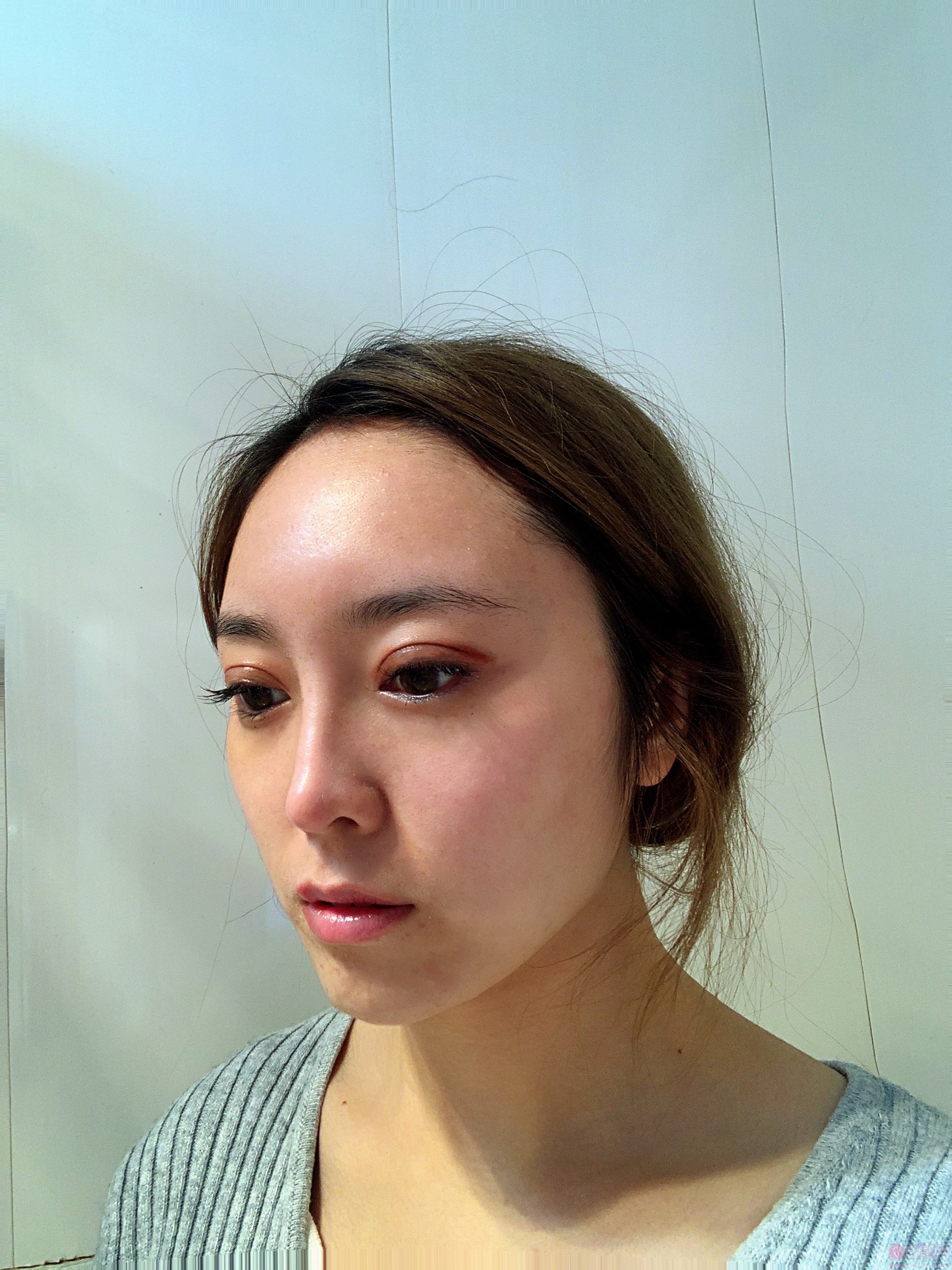 贵阳华美美容医院正规吗?医院简介+双眼皮术后真人案例分享