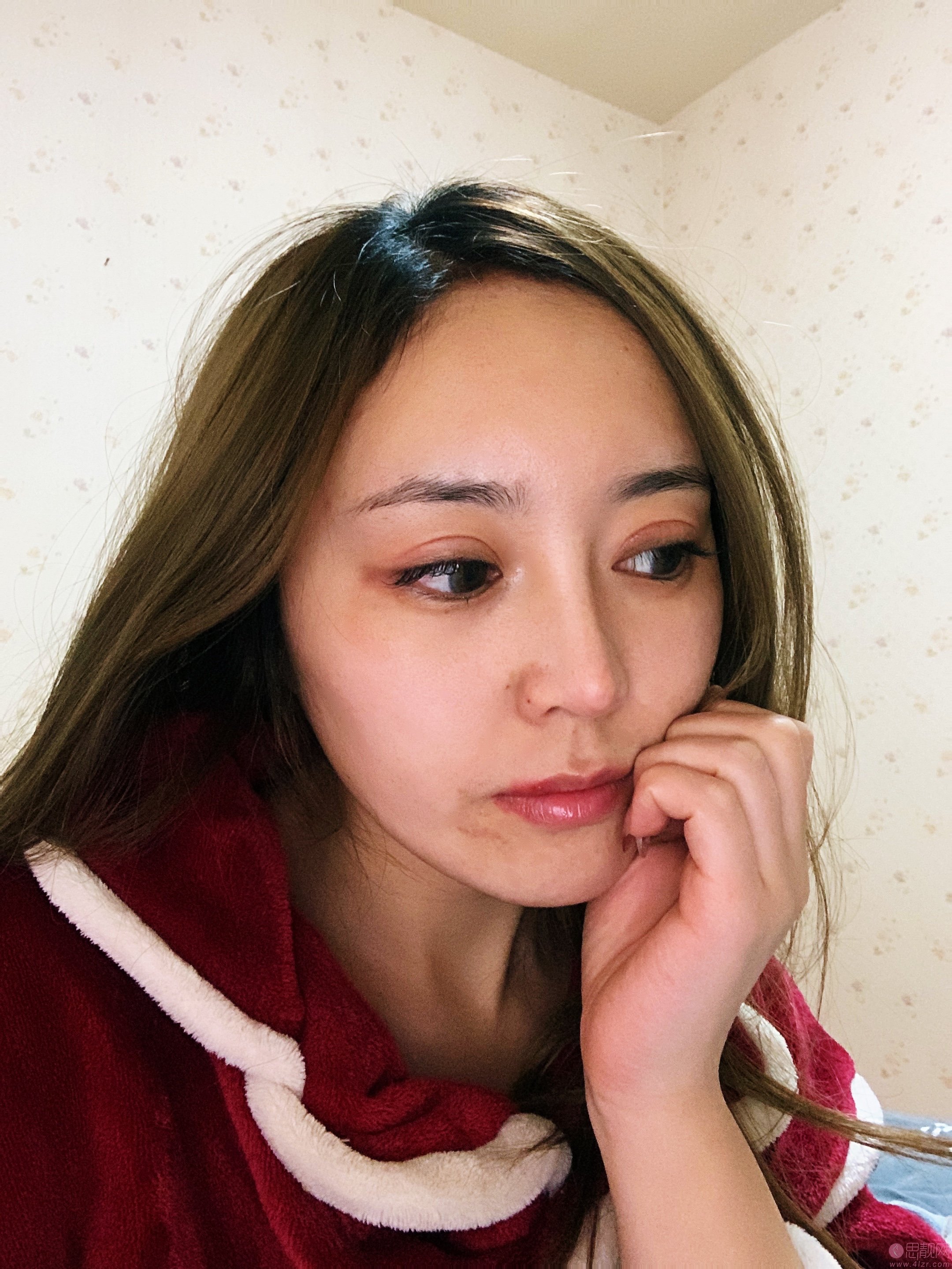贵阳华美美容医院正规吗?医院简介+双眼皮术后真人案例分享