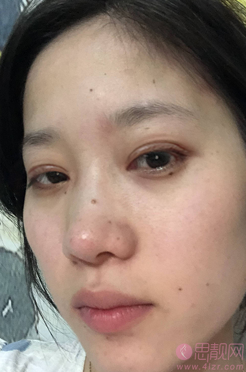 北京凯润婷做双眼皮怎么样?附双眼皮案例分享+2021年价格表发布
