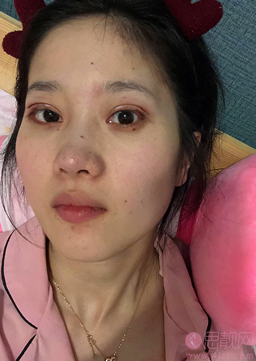 北京凯润婷做双眼皮怎么样?附双眼皮案例分享+2021年价格表发布