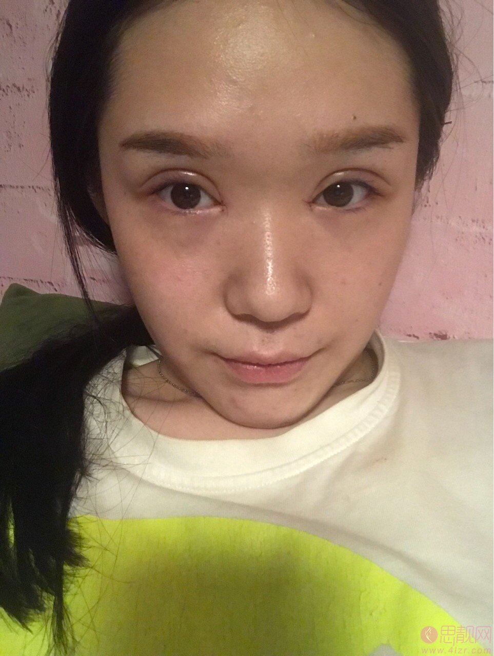 沈阳金皇后做双眼皮好吗?术后真人案例分享及价格表明细曝光
