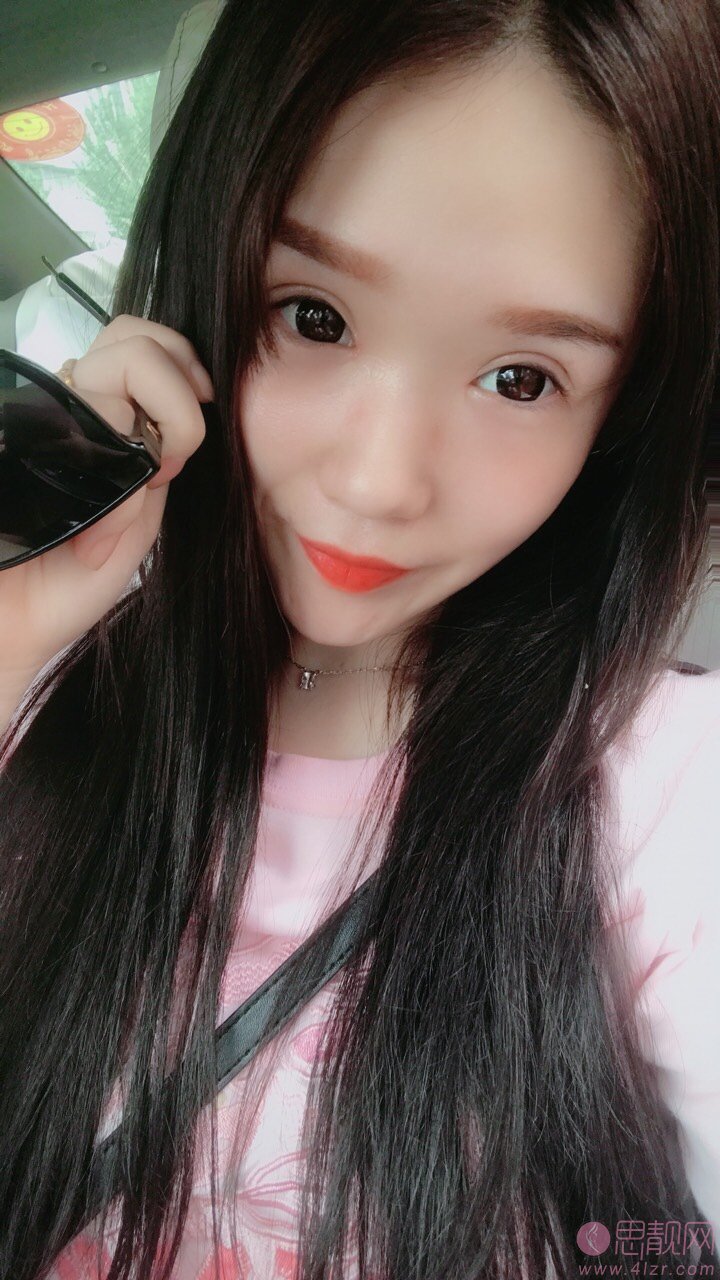 沈阳金皇后做双眼皮好吗?术后真人案例分享及价格表明细曝光