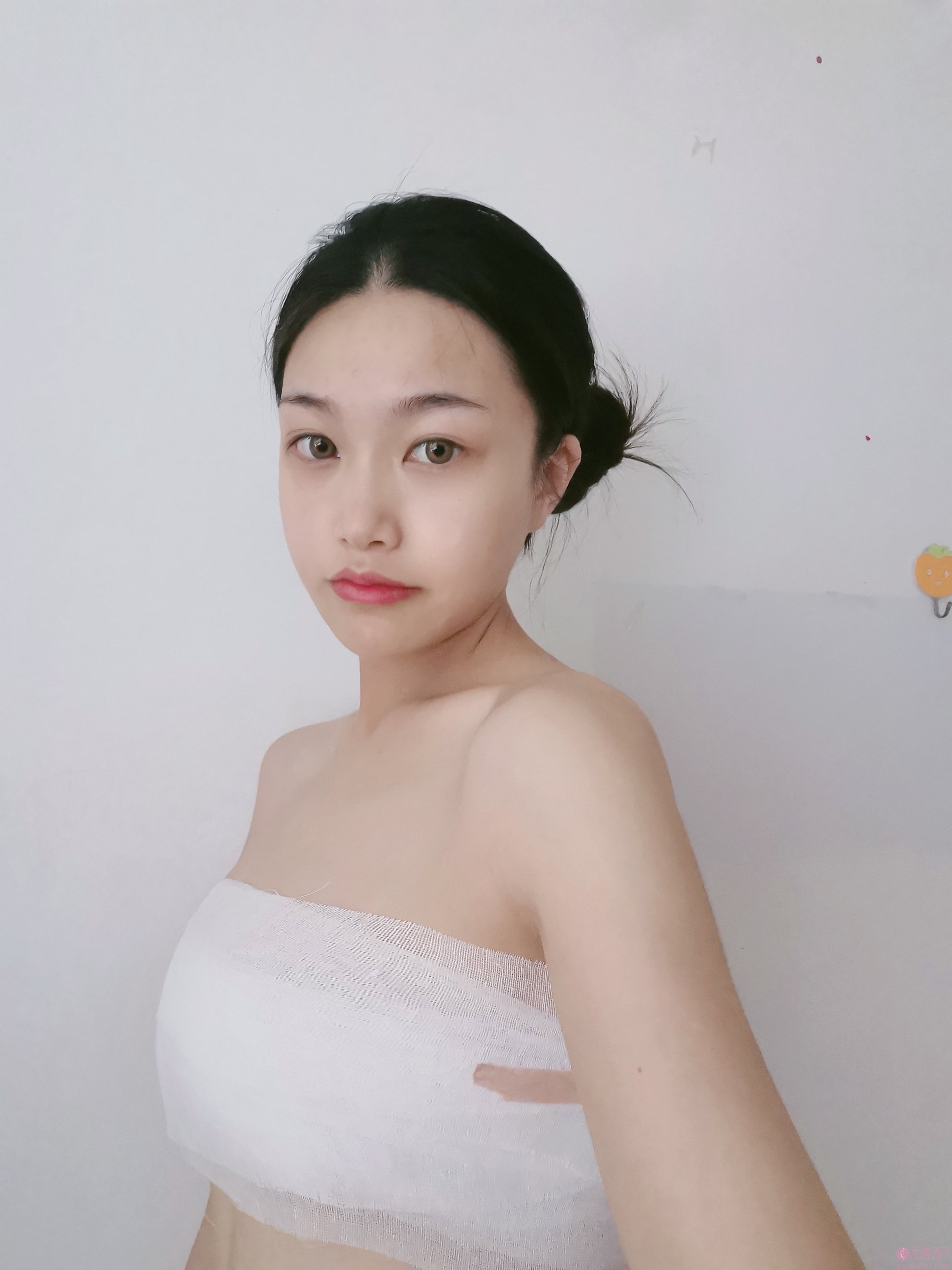 深圳假体隆胸案例分享