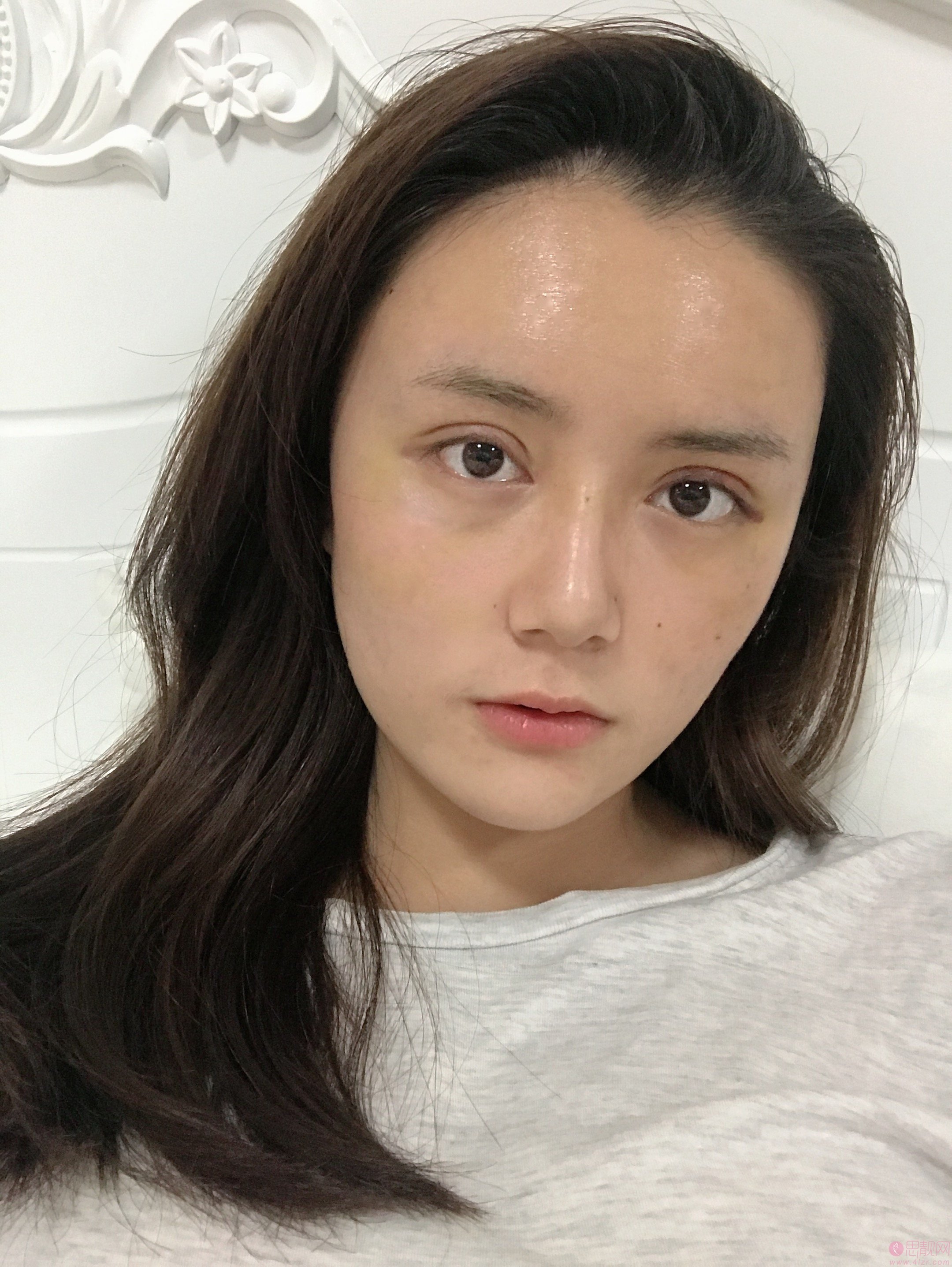 南京华美裴旭芳做双眼皮怎么样？附双眼皮案例及2021价格表一览
