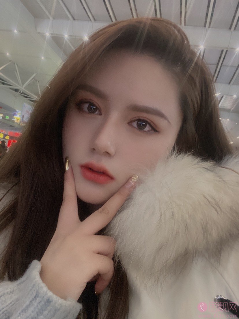 南京华美裴旭芳做双眼皮怎么样？附双眼皮案例及2021价格表一览