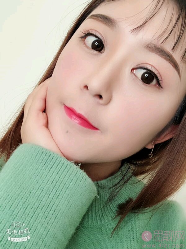 郑州辰星医院做双眼皮怎么样?附双眼皮真人案例分享+2021价格表曝光