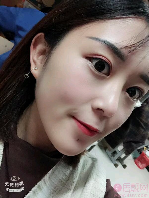 郑州辰星医院做双眼皮怎么样?附双眼皮真人案例分享+2021价格表曝光