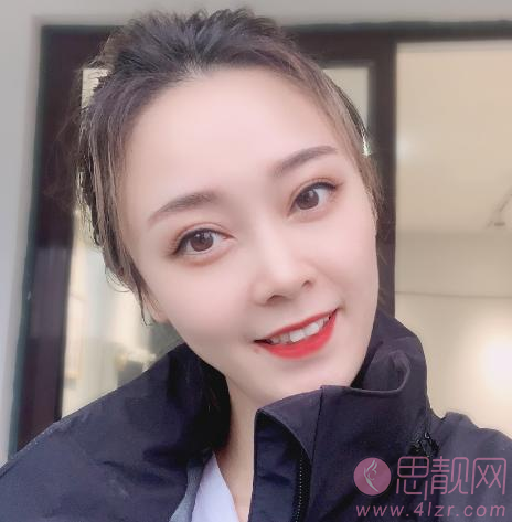 上海赵鹏做鼻子怎么样?看看我的鼻子案例就知道了