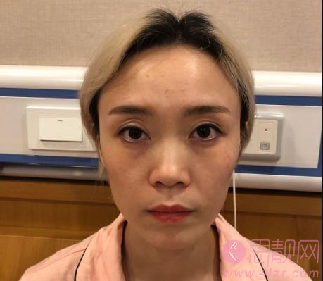 上海赵鹏做鼻子怎么样?看看我的鼻子案例就知道了