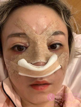 上海赵鹏做鼻子怎么样?看看我的鼻子案例就知道了