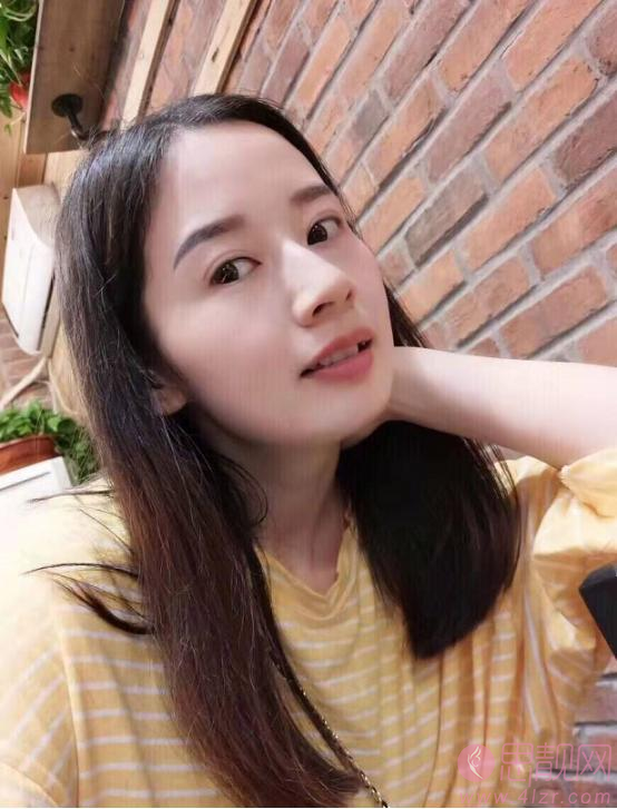 海军总医院于燕做眼袋怎么样?附祛眼袋案例分享+2021年价格表曝光