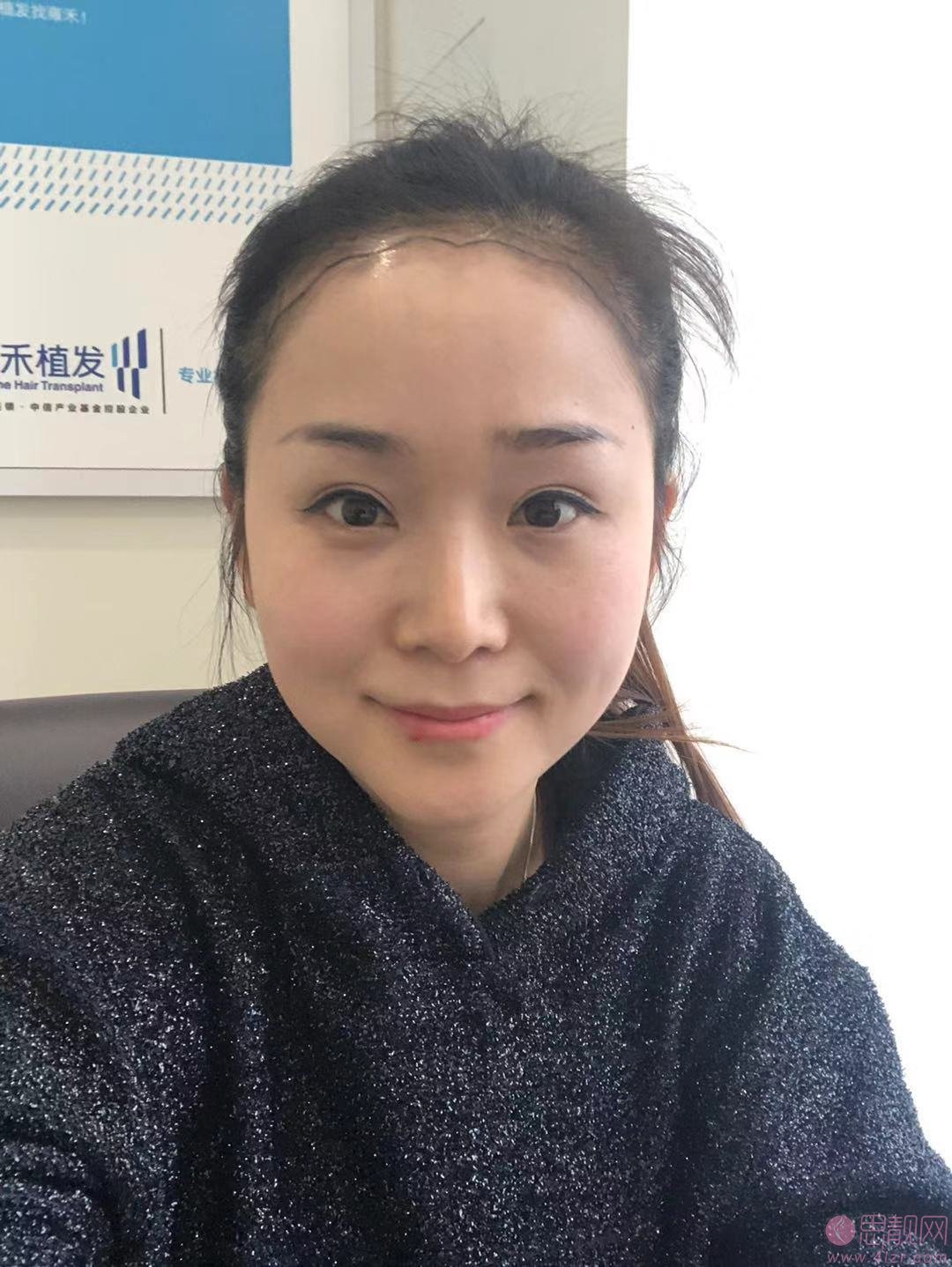 杭州雍禾张东宏植发怎么样?多少钱?2021年价格表一览+案例分享