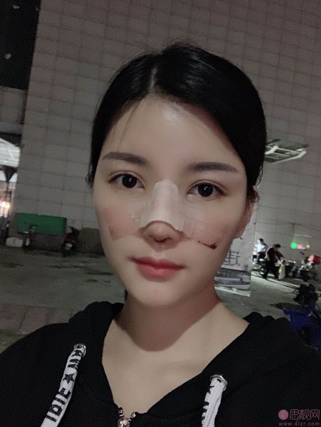 北京画美医院正规吗?附隆鼻真人案例+2021价格表曝光