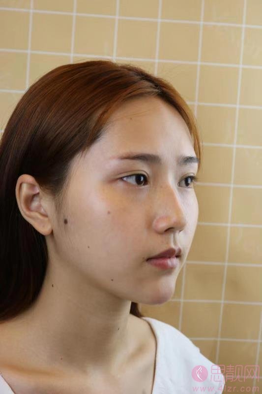 上海艺星整形医院隆鼻如何?多少钱?2021价格表发布+隆鼻真人案例反馈