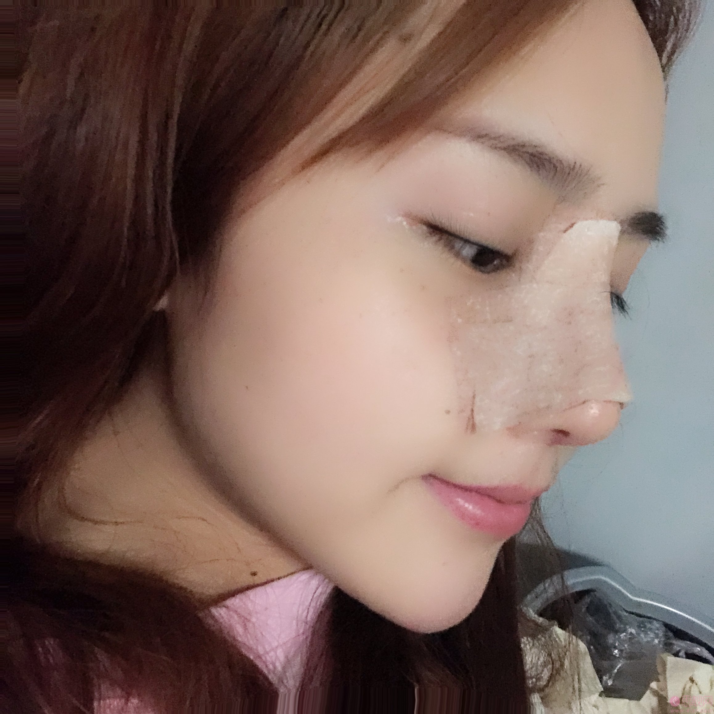 上海艺星整形医院隆鼻如何?多少钱?2021价格表发布+隆鼻真人案例反馈