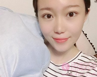 武汉协和医院冯晓玲双眼皮案例分享+2021年价格表公布