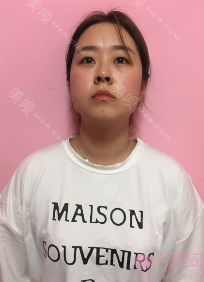 上海仁爱医院刘先超磨骨技术怎么样？附医生简介介绍+磨骨真人案例分享